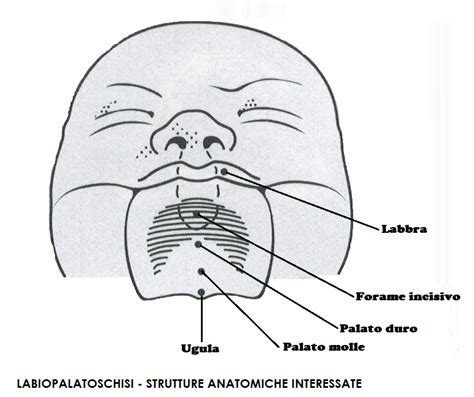 Illustrazione della palatoschisi congenita