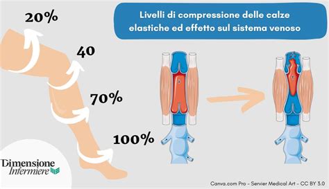 infografica che mostra la compressione graduata dalla caviglia alla coscia