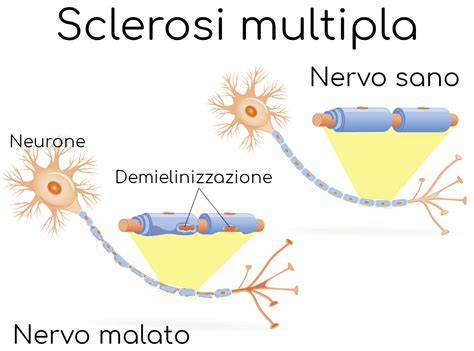 Illustrazione stilizzata del cervello con placche di sclerosi multipla
